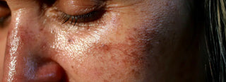 Quali sono i migliori trattamenti naturali per rimuovere le macchie scure sul viso?
